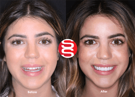 Porcelain Veneers